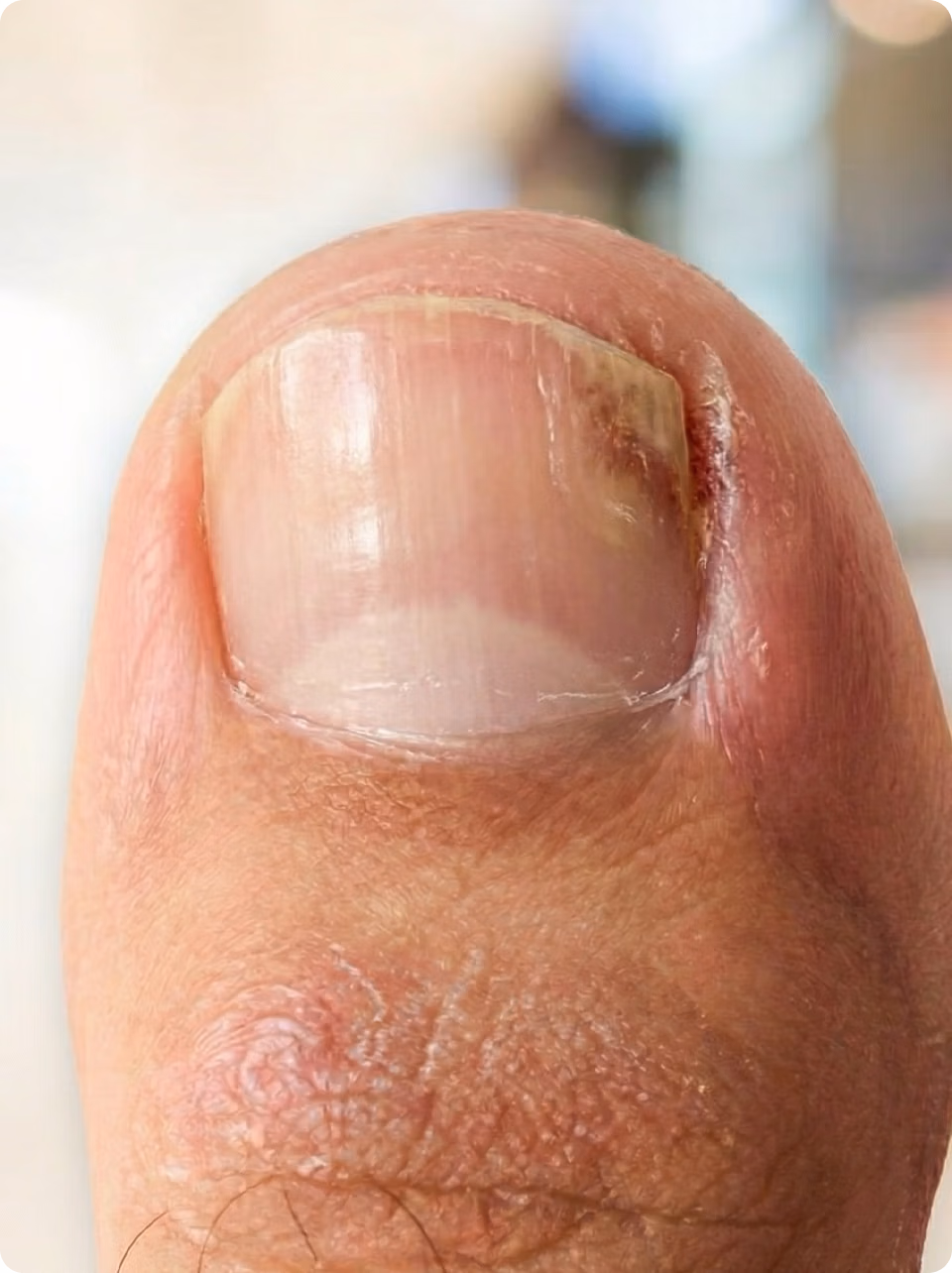 Untreated fungus
